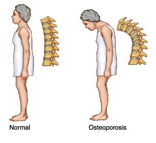 Osteoporosis Curvature